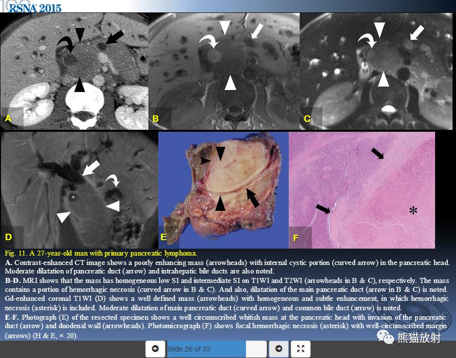 rsna精彩幻燈丨胰腺腫瘤who分類實性腫瘤及腫瘤樣病變的影像表現雙語