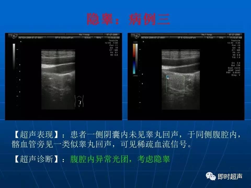 阴囊珠超声图片图片