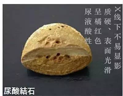 肾结石成分图片