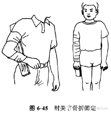 用两块带状三角巾或绷带把伤肢和夹板固定,再用一块燕尾三角巾悬吊伤