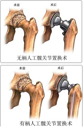 股骨頭壞死分期標準是什麼