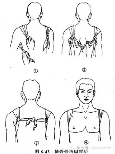 (1)锁骨骨折固定:将两条指宽的带状三角巾分别环绕两个肩关节,于肩部