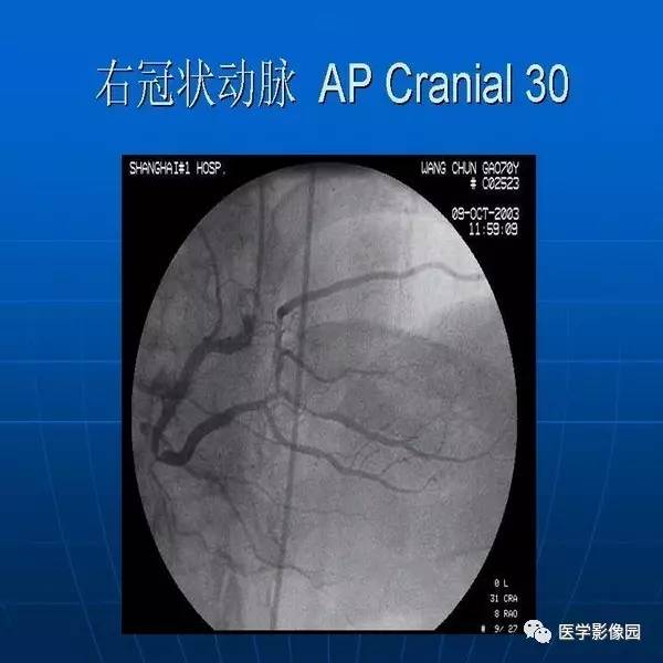 冠脈解剖與冠脈造影閱讀丨影像天地