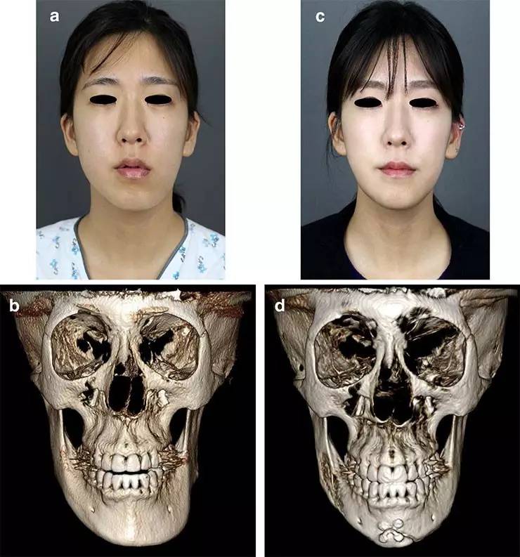 26岁女性,下颌骨不对称,(ab)术前;(cd)术后3个月21岁男性,右侧面部