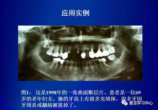 牙周夾板的分類及臨床應用