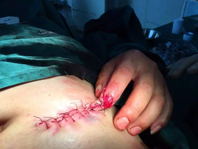云南航天医院成功完成一台食指末节腹部皮瓣埋藏术