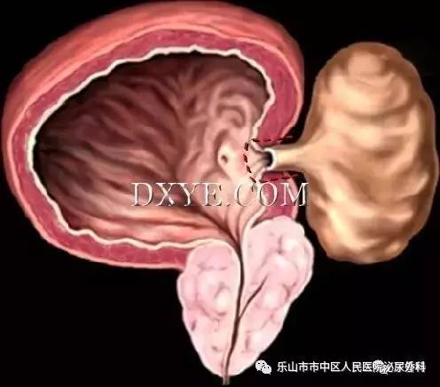 ct顯示患者膀胱右後方有一巨大囊性包塊,直徑達15cm.