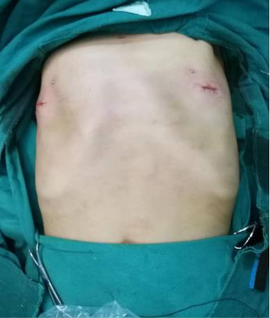 术后患者为5岁男性,发现胸壁畸形5年,查体:胸廓扁平,胸骨凹陷明显,呈
