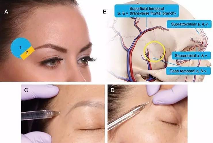 眉毛塑形,额头塑形)&肉毒毒素(额头横纹,眉间纹,鱼尾纹,提眉,增大眼睛