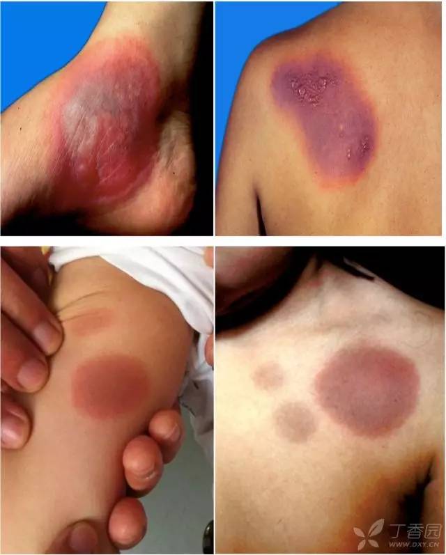 图解药疹的7种皮损表现与诊治