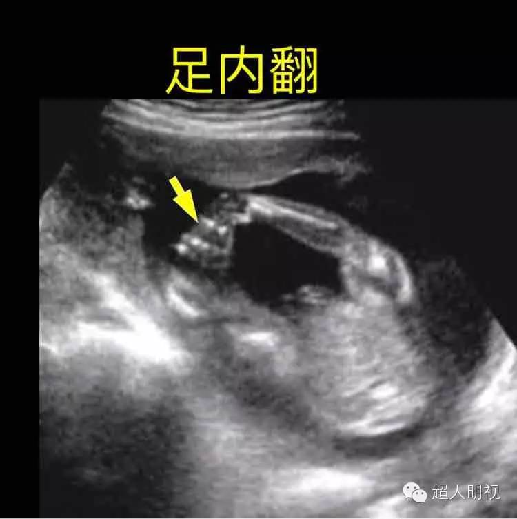 胎儿双足内翻姿势图片图片