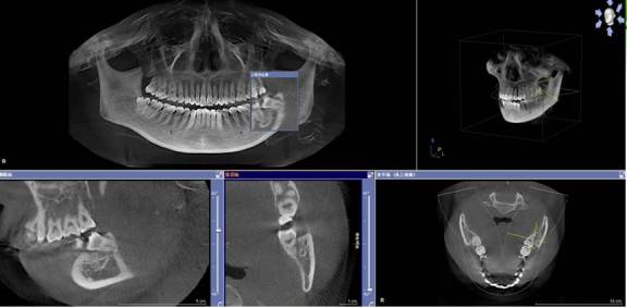 口腔ct冠状面图片