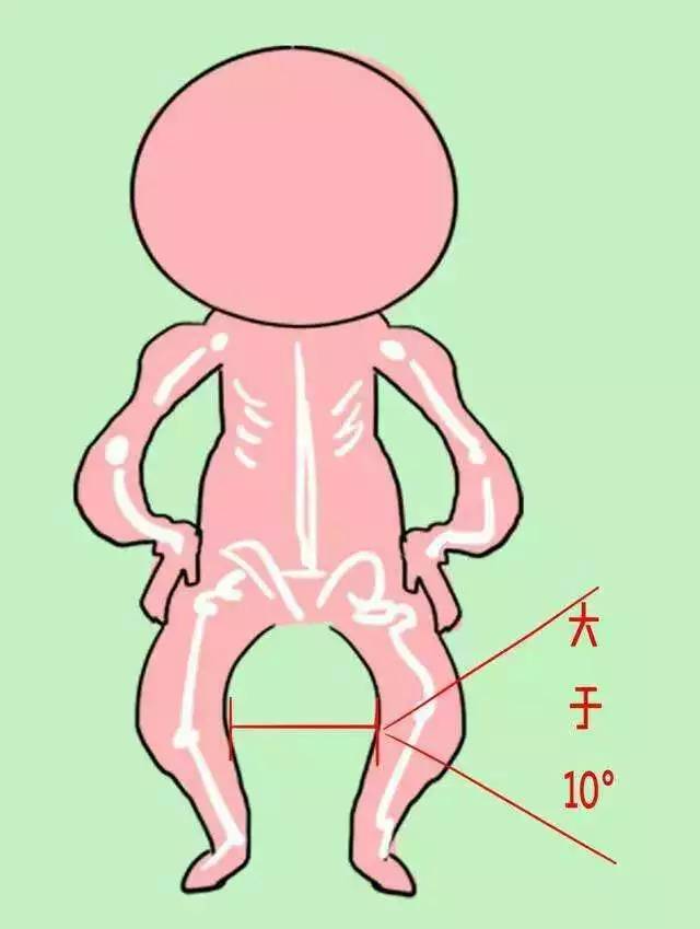 絕對!羅圈腿遺傳嗎