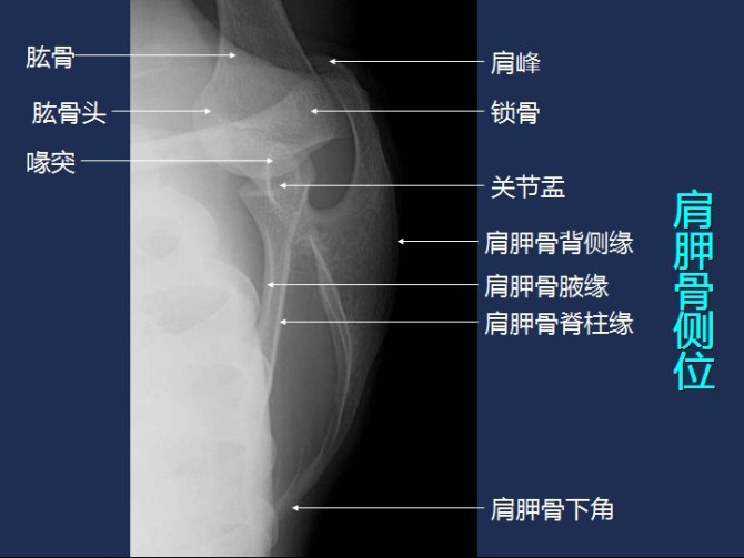 肩胛骨影像解剖图片