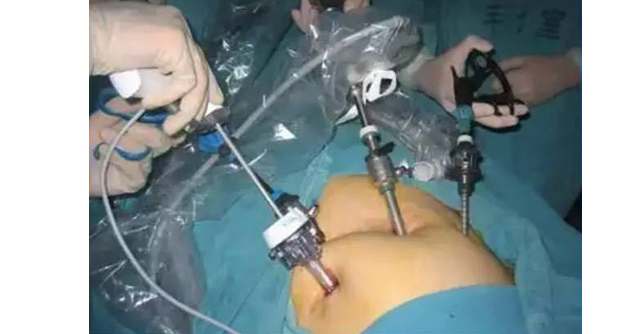 女人手术腹部图片
