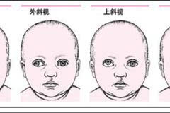 斗鸡眼和斜视哪个严重斗鸡眼斜视图片