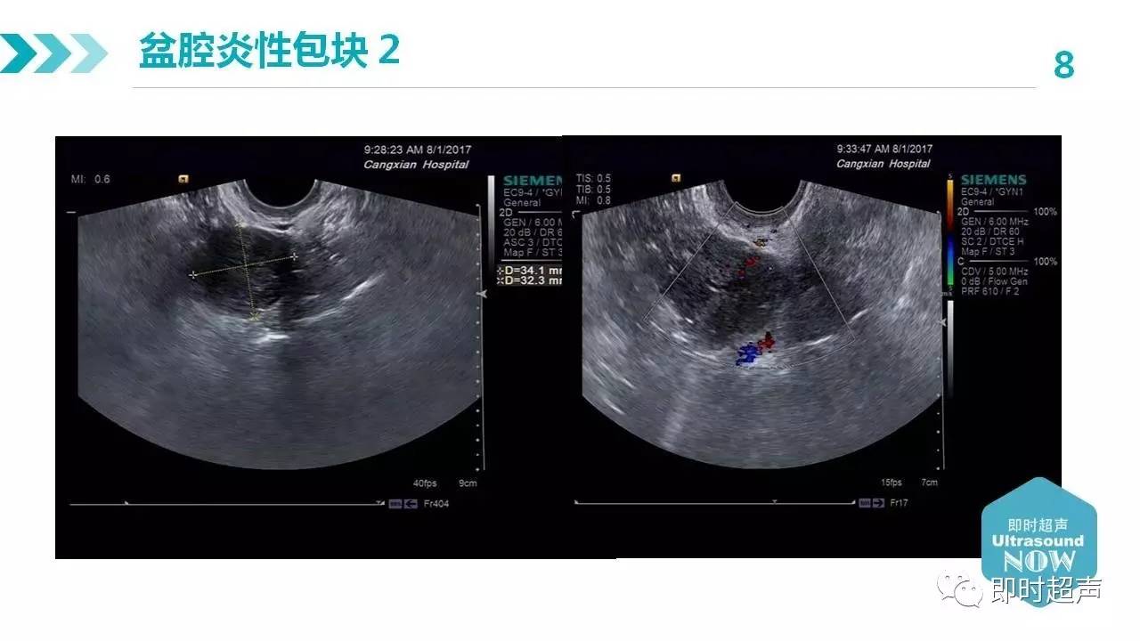 超聲直播婦科急腹症的超聲診斷二炎性包塊vs卵巢腫物扭轉