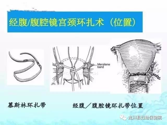 mersilene环扎带图片