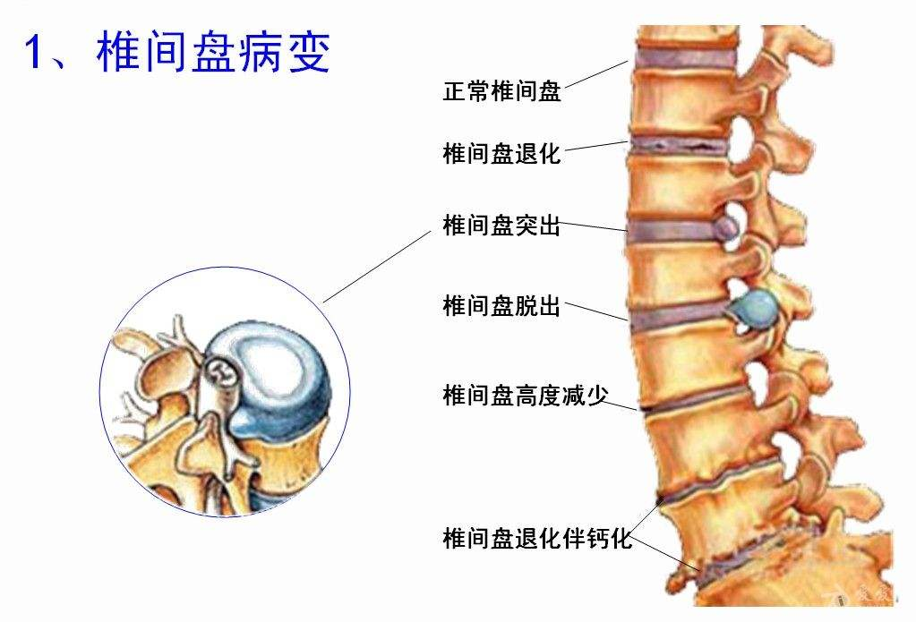 腰5骶1椎间盘位置图图片