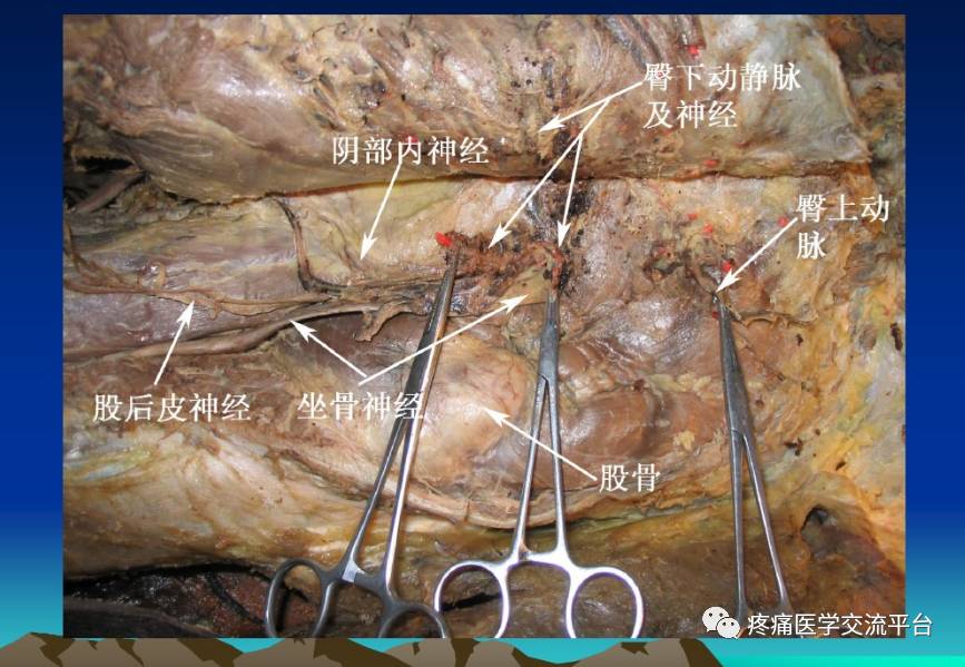 頸項部①針刀治療項韌帶損傷②針刀治療胸鎖乳突肌損傷③針刀治療肩胛