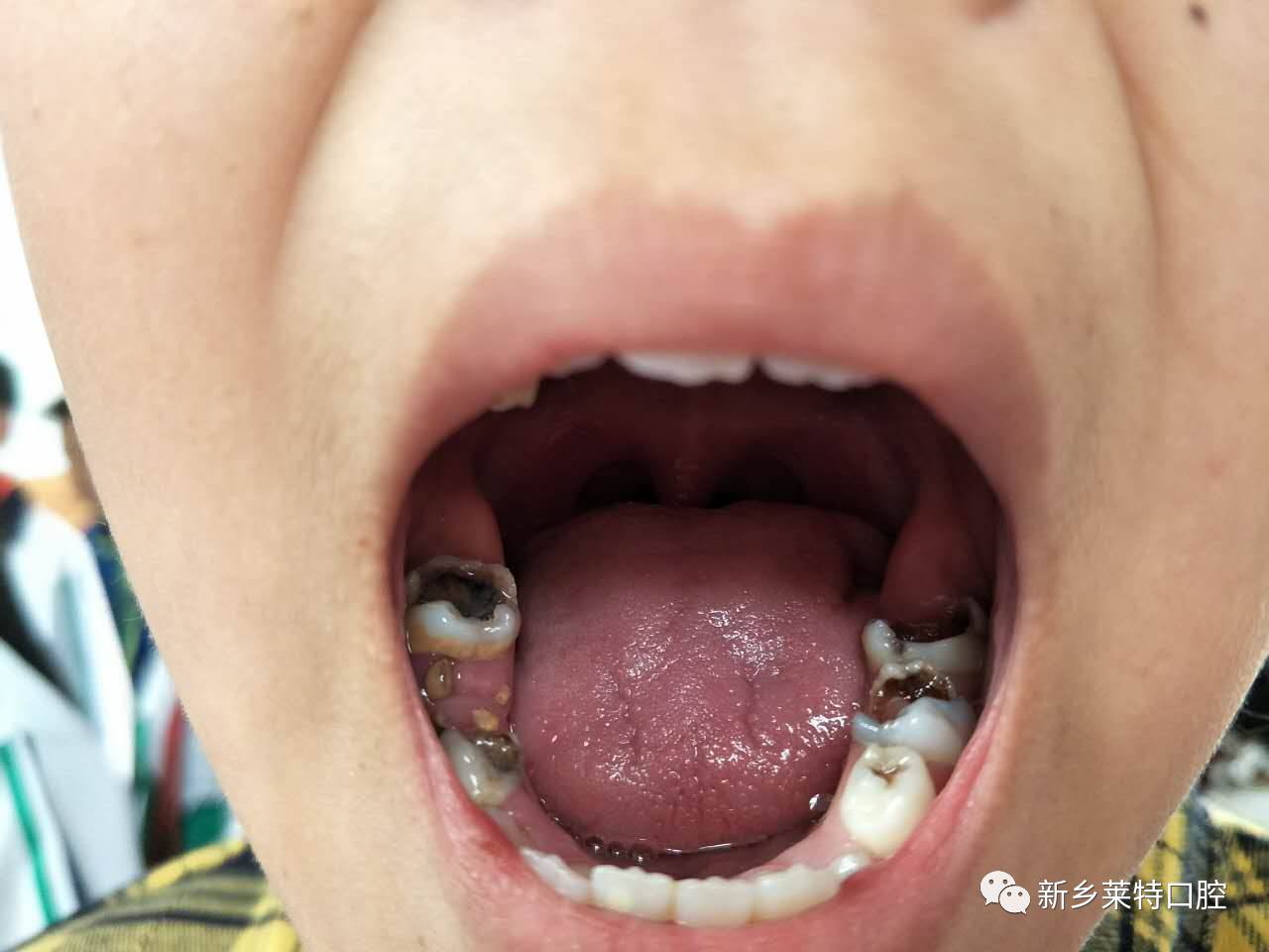 六龄齿,是在孩子6岁左右长出的第一颗恒磨牙,总共四颗,一生只长一次