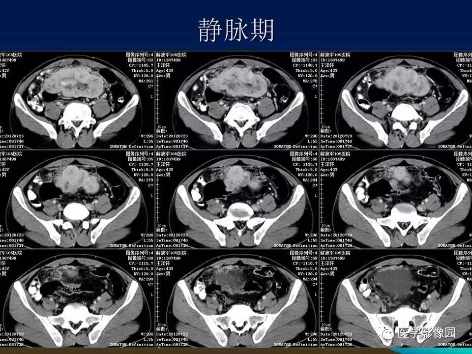 小腸間質瘤與腸腔貫通等你分析丨讀片專欄530期