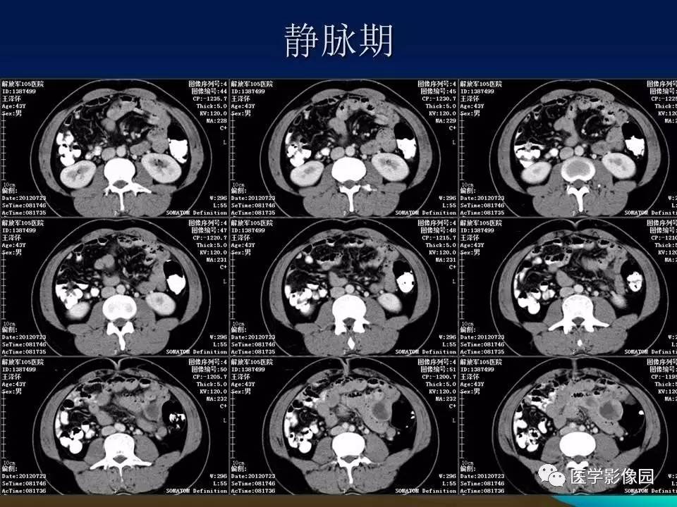 小腸間質瘤與腸腔貫通等你分析丨讀片專欄530期