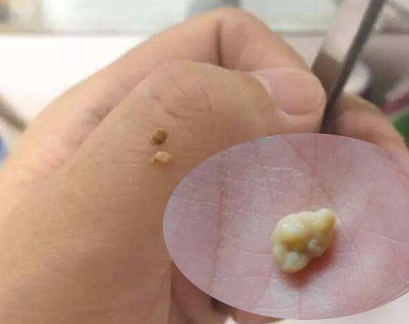 也会咳出来一些类似颗粒,还以为是吃饭的残渣,被医生告知是扁桃体结石