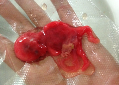 人流手术有哪些影响可能会发生出血感染子宫穿孔