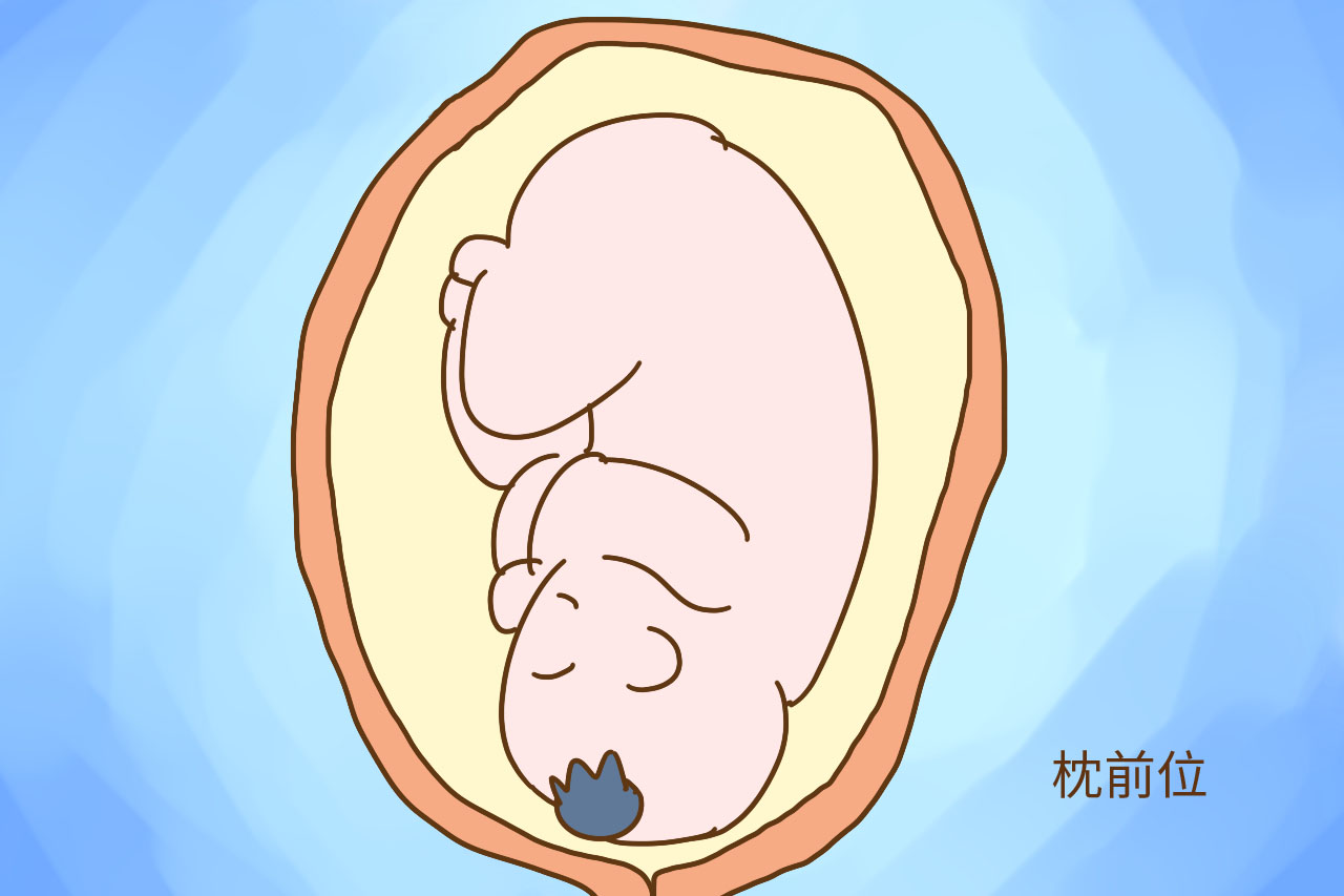 【孕妈妈福音】我院产科专家实施 “外倒转术”，为孕妈妈转正胎位_剖宫产